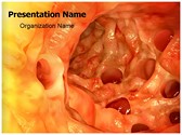 Diverticulosis PowerPoint Templates