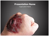 Burned Hand Editable PowerPoint Template